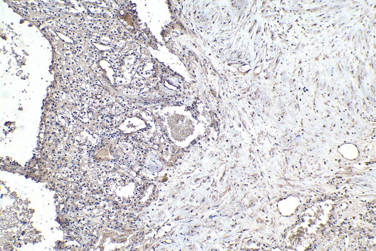 Immunohistochemistry (IHC) staining of human renal cell carcinoma tissue using ECD Monoclonal antibody (67179-1-Ig)