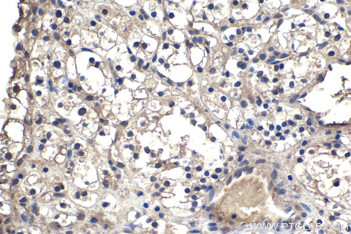 Immunohistochemistry (IHC) staining of human renal cell carcinoma tissue using ECD Monoclonal antibody (67179-1-Ig)