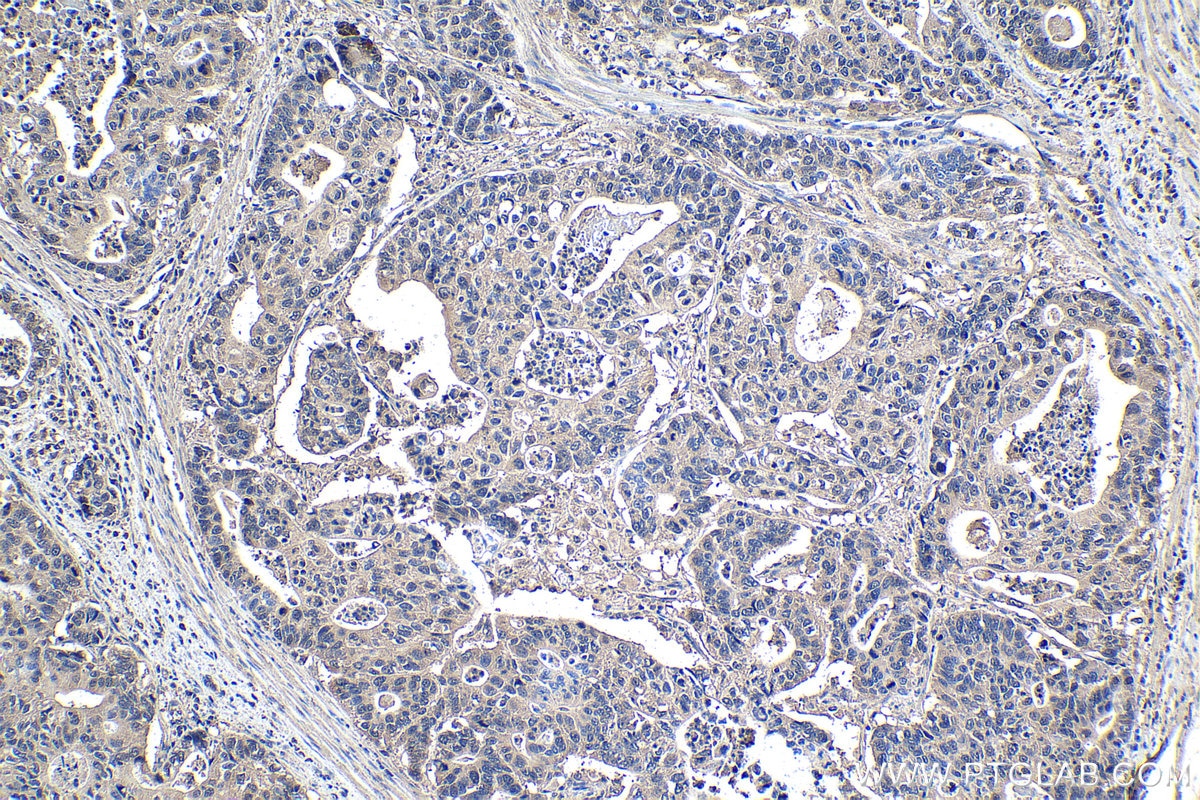 Immunohistochemistry (IHC) staining of human stomach cancer tissue using ECD Monoclonal antibody (67179-1-Ig)