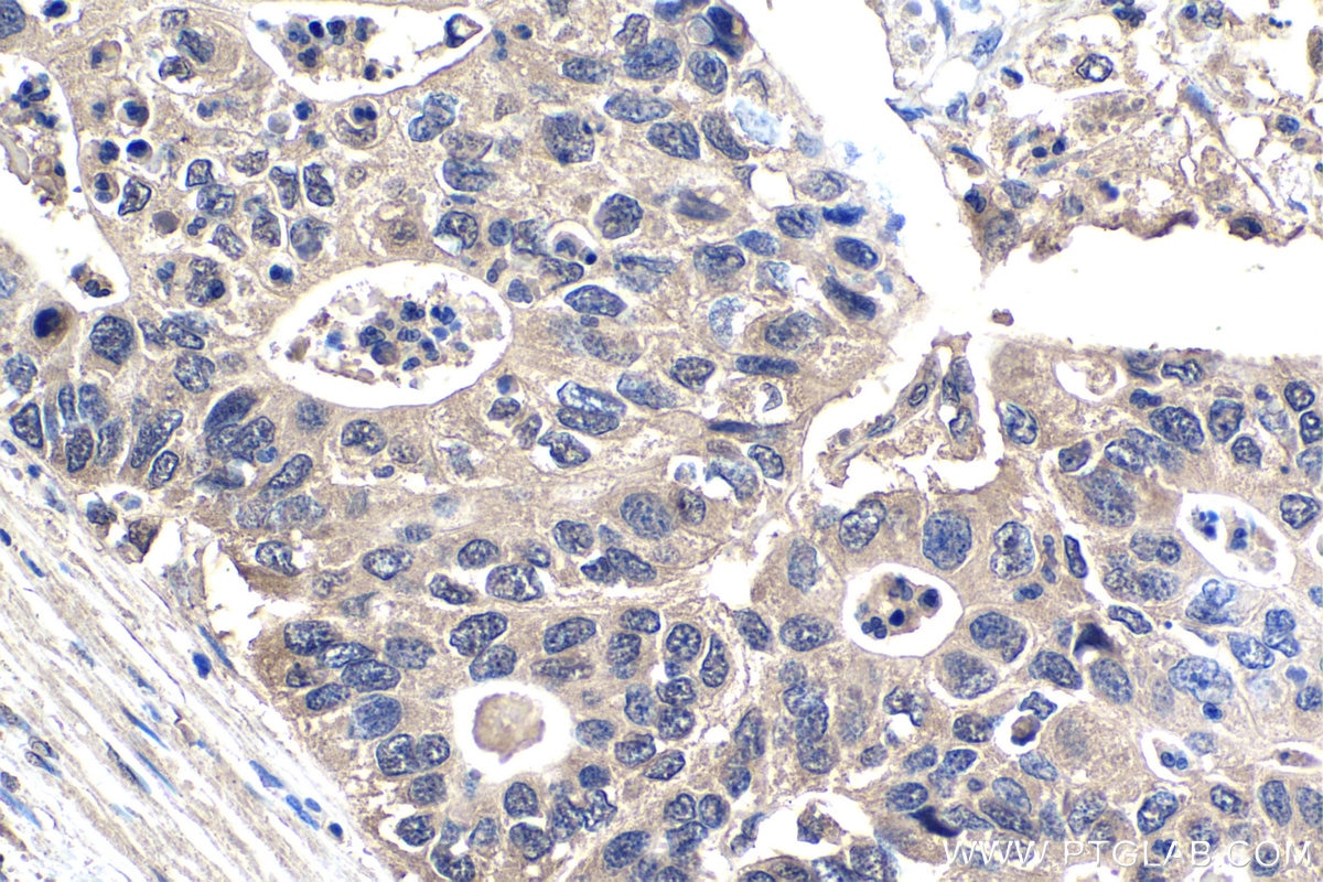 Immunohistochemistry (IHC) staining of human stomach cancer tissue using ECD Monoclonal antibody (67179-1-Ig)