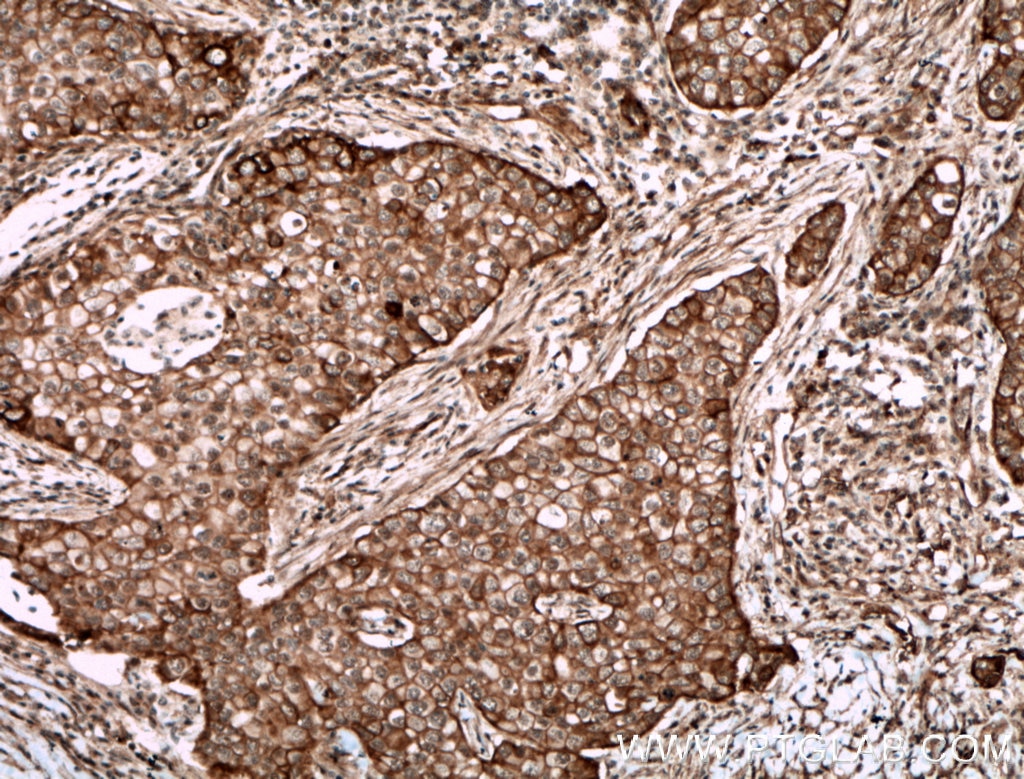 Immunohistochemistry (IHC) staining of human breast cancer tissue using ECE1 Polyclonal antibody (26088-1-AP)