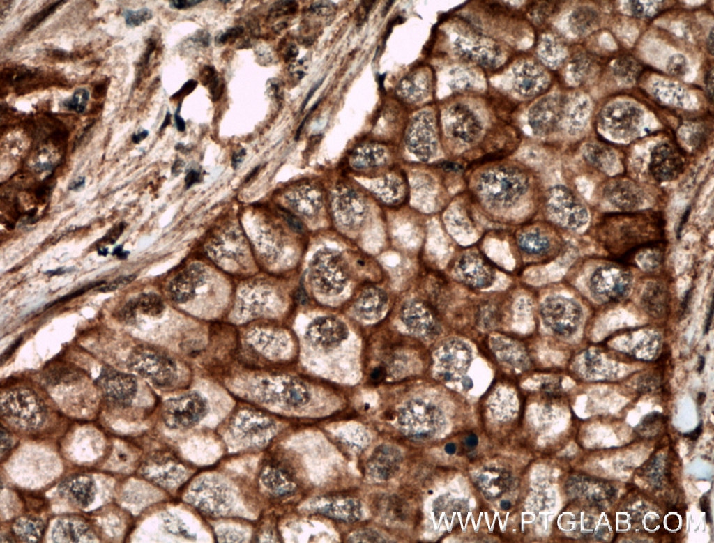 Immunohistochemistry (IHC) staining of human breast cancer tissue using ECE1 Polyclonal antibody (26088-1-AP)