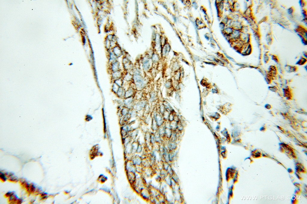 Immunohistochemistry (IHC) staining of human pancreas cancer tissue using ECH1 Polyclonal antibody (11385-1-AP)