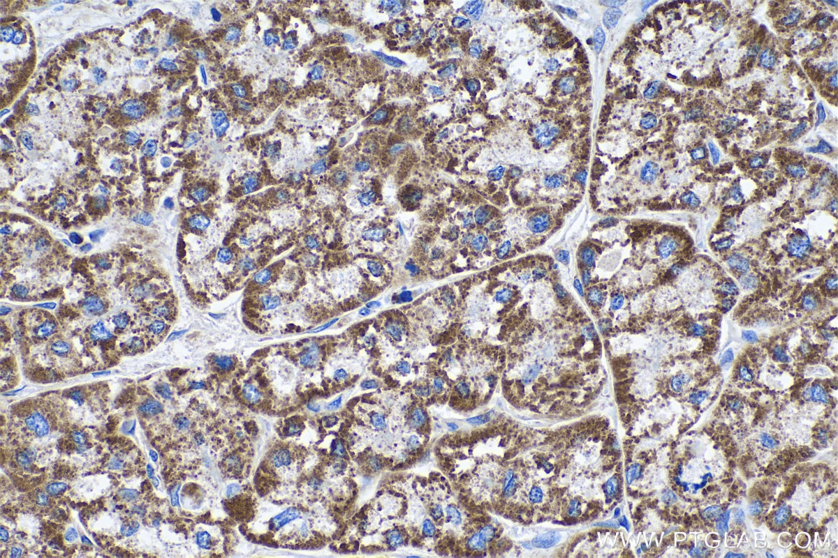Immunohistochemistry (IHC) staining of human liver cancer tissue using ECH1 Monoclonal antibody (68139-1-Ig)