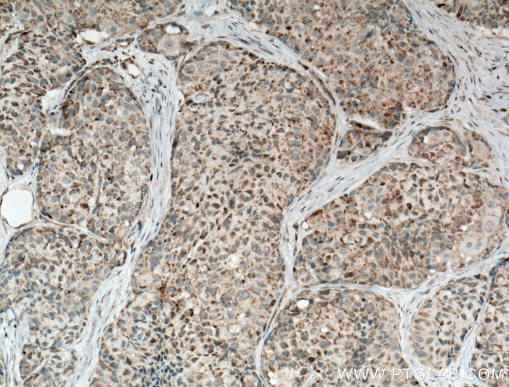 Immunohistochemistry (IHC) staining of human lung cancer tissue using ECHDC1 Polyclonal antibody (27732-1-AP)