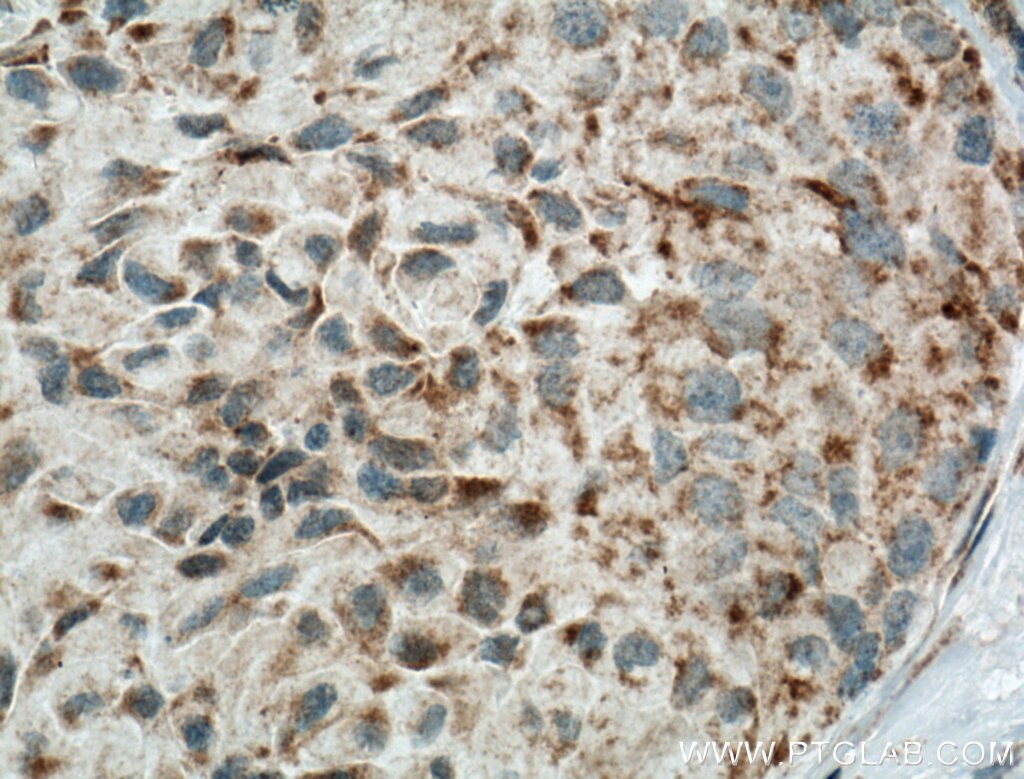 Immunohistochemistry (IHC) staining of human lung cancer tissue using ECHDC1 Polyclonal antibody (27732-1-AP)