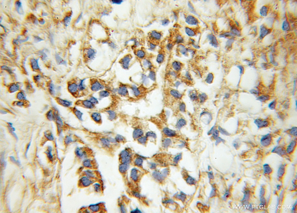 Immunohistochemistry (IHC) staining of human prostate cancer tissue using ECHS1 Polyclonal antibody (11305-1-AP)
