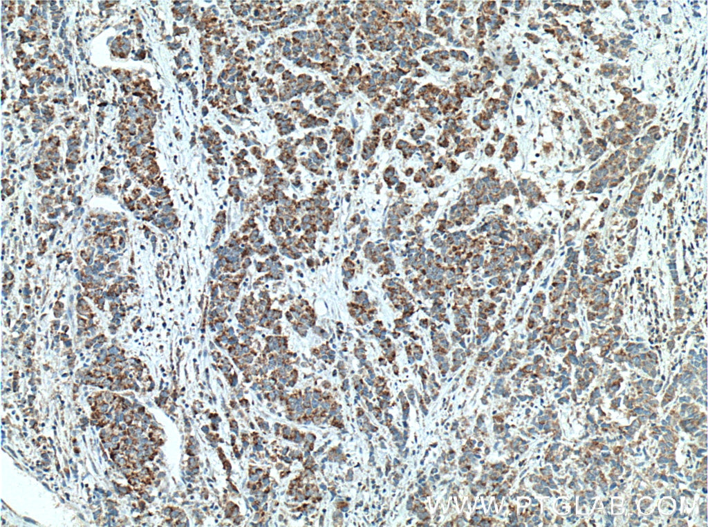 Immunohistochemistry (IHC) staining of human prostate cancer tissue using ECHS1 Monoclonal antibody (66117-1-Ig)