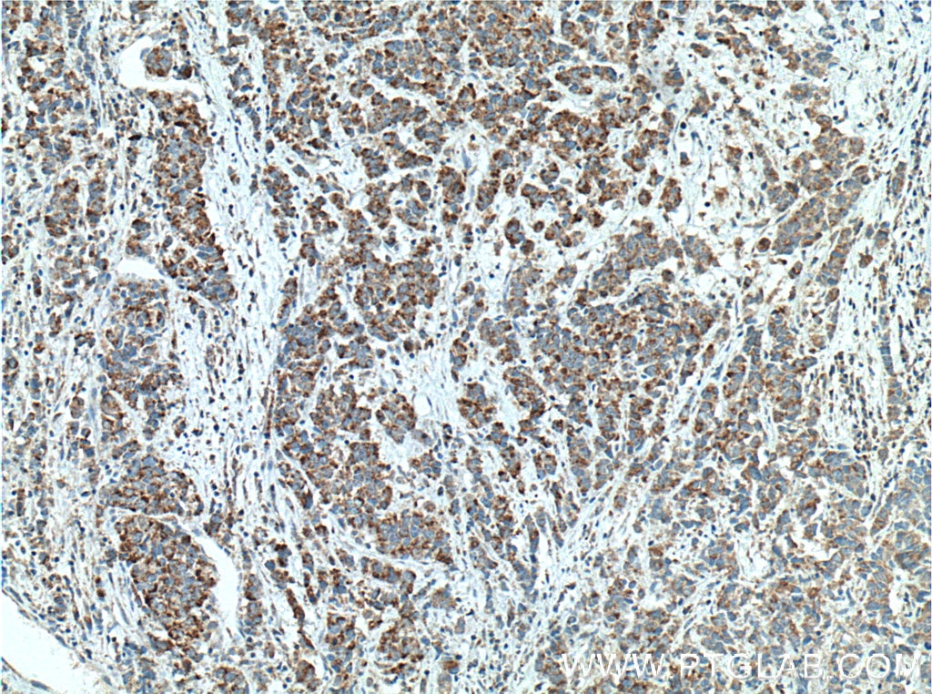 IHC staining of human prostate cancer using 66117-1-Ig