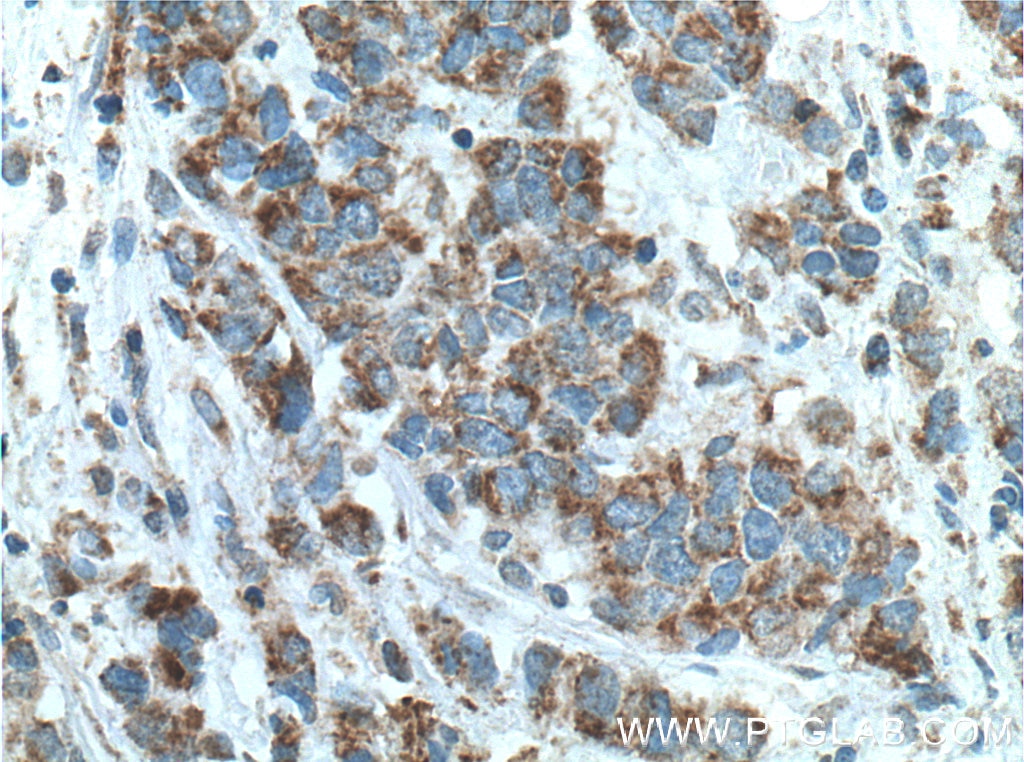 Immunohistochemistry (IHC) staining of human prostate cancer tissue using ECHS1 Monoclonal antibody (66117-1-Ig)