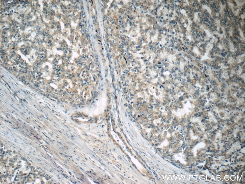 Immunohistochemistry (IHC) staining of human prostate cancer tissue using ECHS1 Monoclonal antibody (66117-1-Ig)