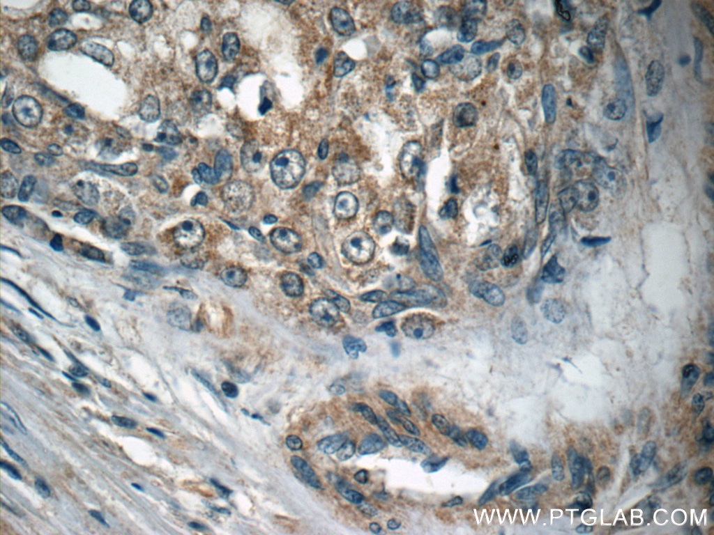 IHC staining of human prostate cancer using 66117-1-Ig