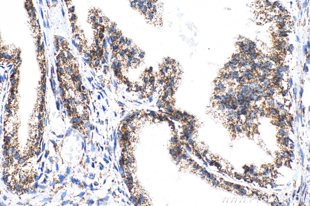 Immunohistochemistry (IHC) staining of human prostate cancer tissue using ECHS1 Recombinant antibody (81611-1-RR)