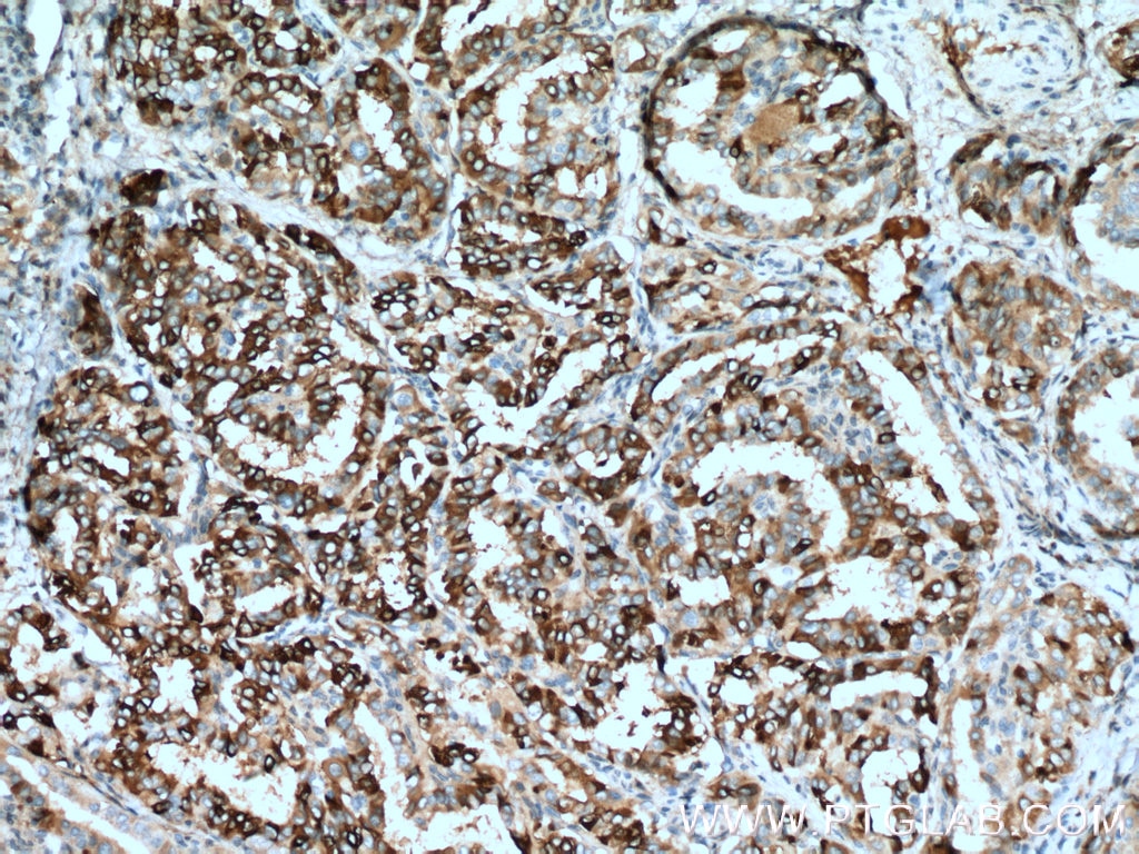 IHC staining of human thyroid cancer using 11521-1-AP