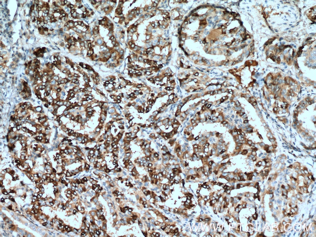 Immunohistochemistry (IHC) staining of human thyroid cancer tissue using ECM1 Polyclonal antibody (11521-1-AP)