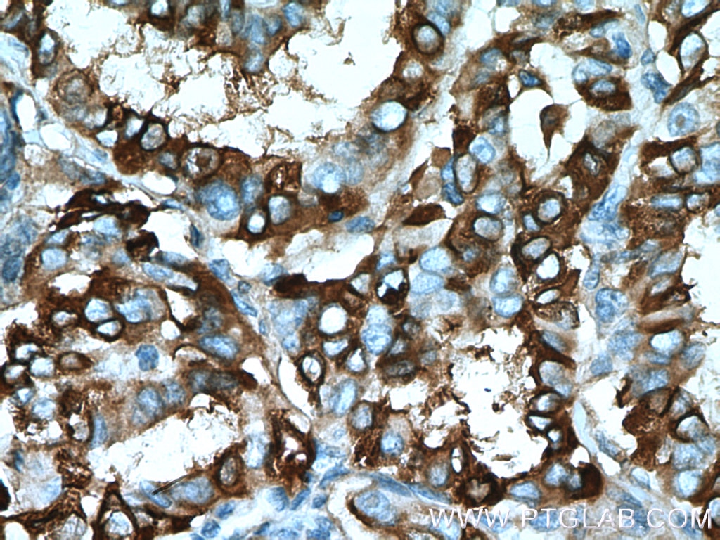 Immunohistochemistry (IHC) staining of human thyroid cancer tissue using ECM1 Polyclonal antibody (11521-1-AP)