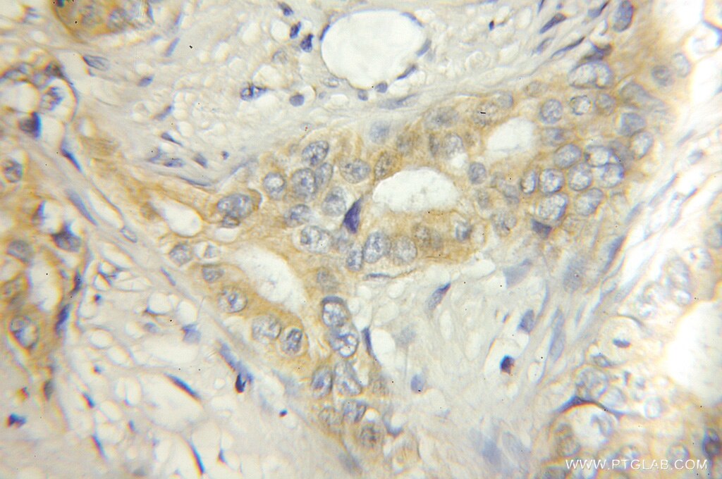 Immunohistochemistry (IHC) staining of human pancreas cancer tissue using ECM1 Polyclonal antibody (11521-1-AP)