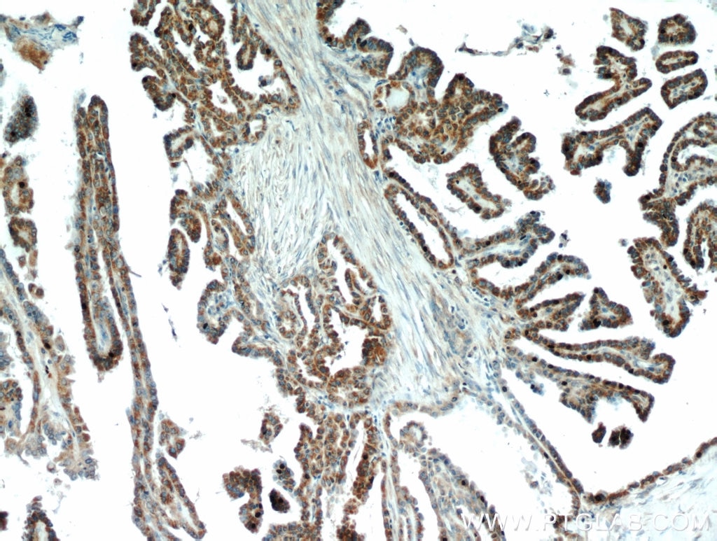 Immunohistochemistry (IHC) staining of human thyroid cancer tissue using ECM1 Polyclonal antibody (11521-1-AP)