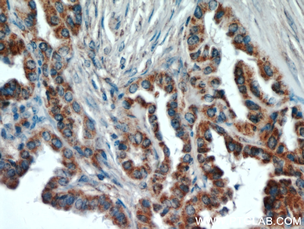 Immunohistochemistry (IHC) staining of human thyroid cancer tissue using ECM1 Polyclonal antibody (11521-1-AP)