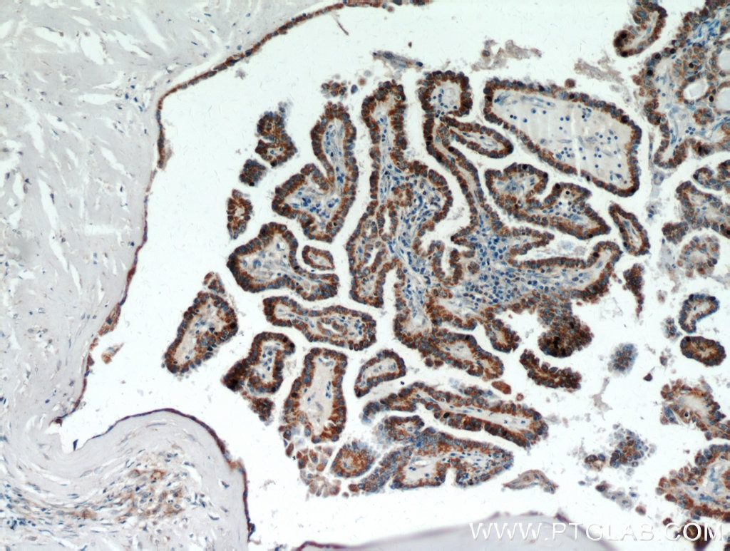 IHC staining of human thyroid cancer using 11521-1-AP