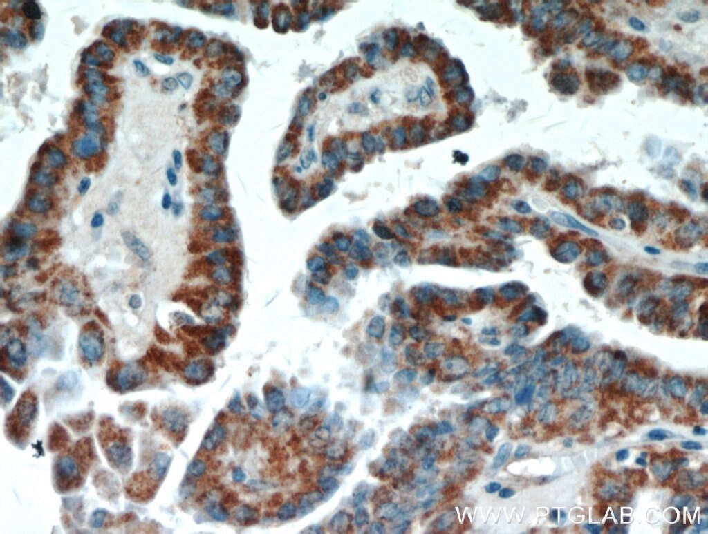 Immunohistochemistry (IHC) staining of human thyroid cancer tissue using ECM1 Polyclonal antibody (11521-1-AP)