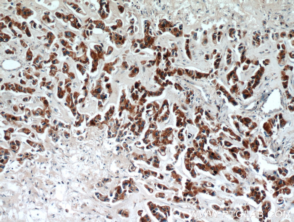 Immunohistochemistry (IHC) staining of human breast cancer tissue using ECM1 Polyclonal antibody (11521-1-AP)