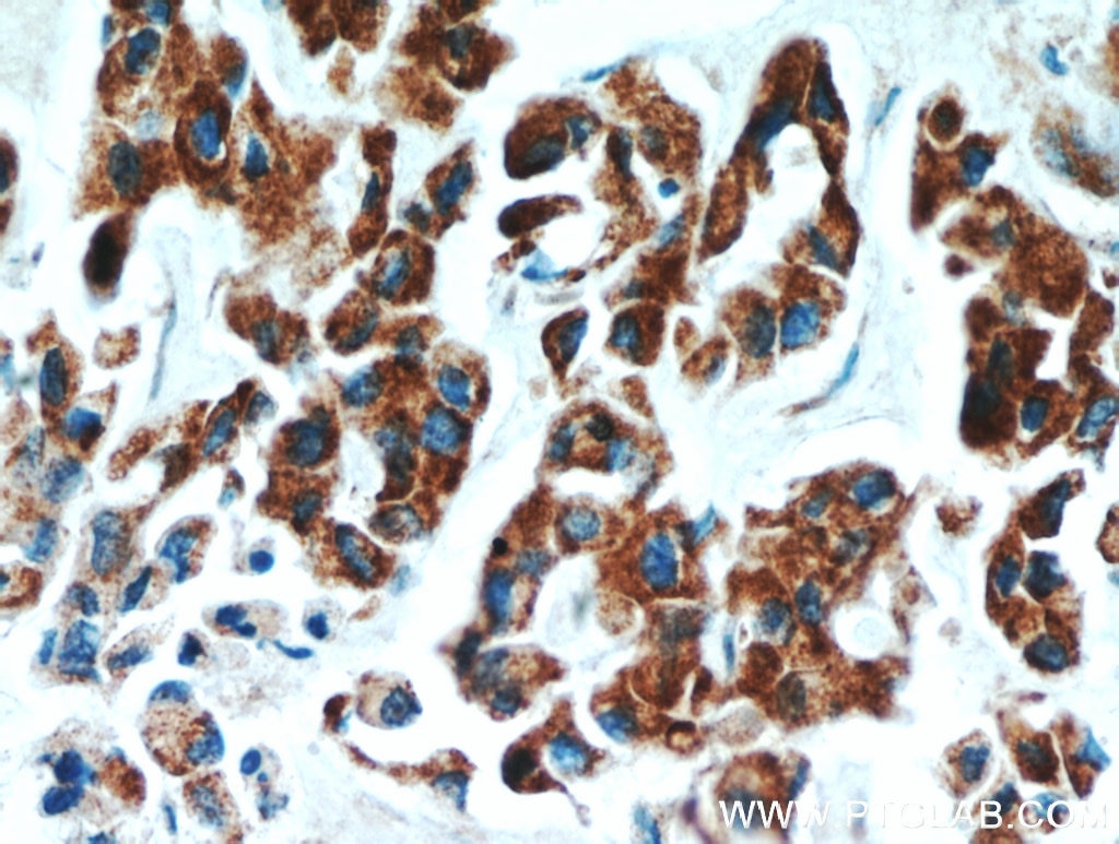 IHC staining of human breast cancer using 11521-1-AP