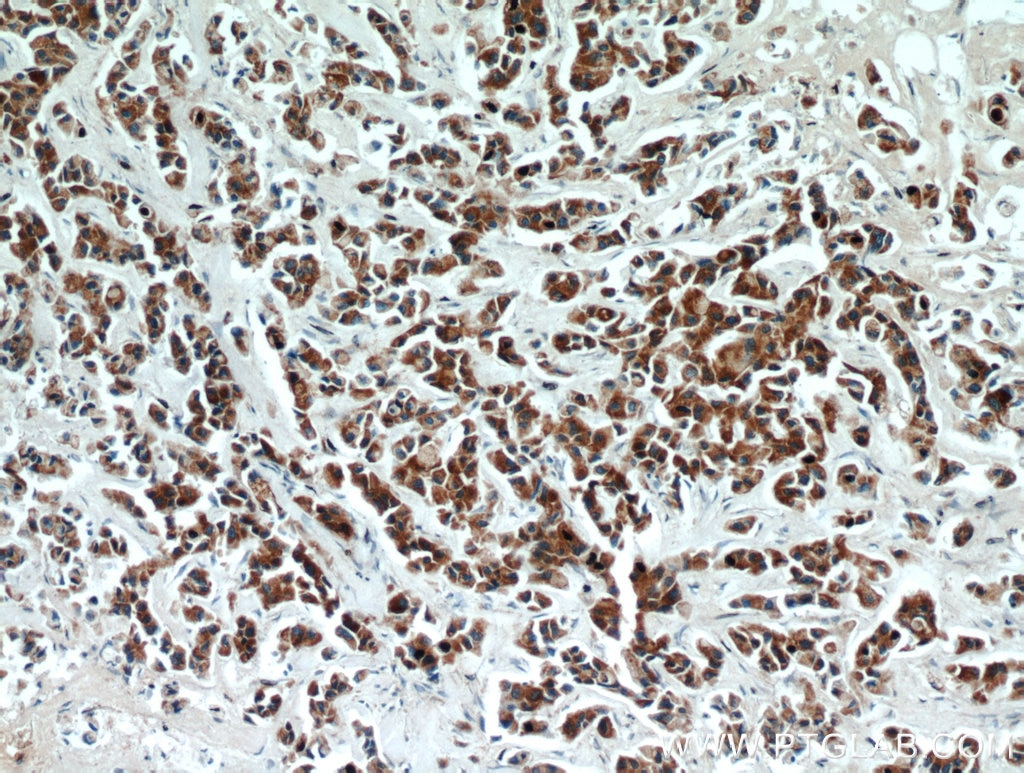 Immunohistochemistry (IHC) staining of human breast cancer tissue using ECM1 Polyclonal antibody (11521-1-AP)