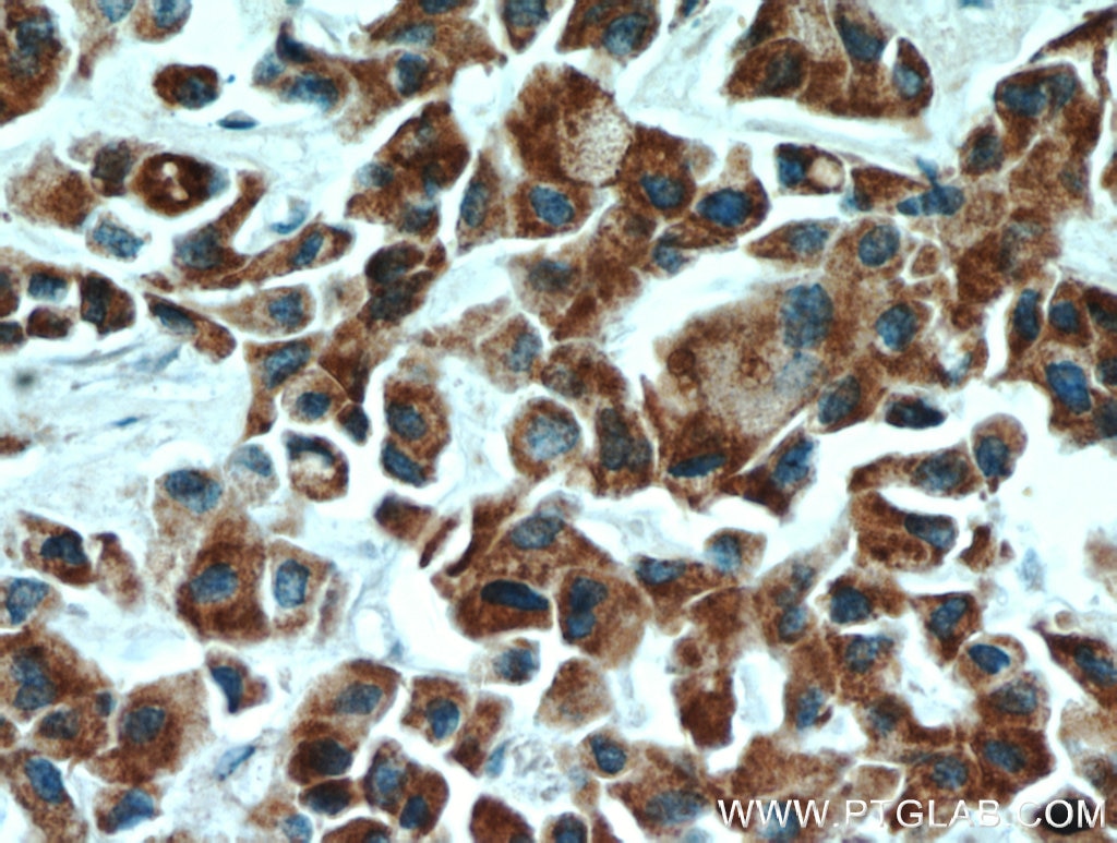 Immunohistochemistry (IHC) staining of human breast cancer tissue using ECM1 Polyclonal antibody (11521-1-AP)