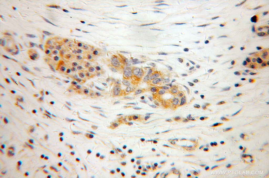Immunohistochemistry (IHC) staining of human pancreas cancer tissue using ECM1 Polyclonal antibody (11521-1-AP)