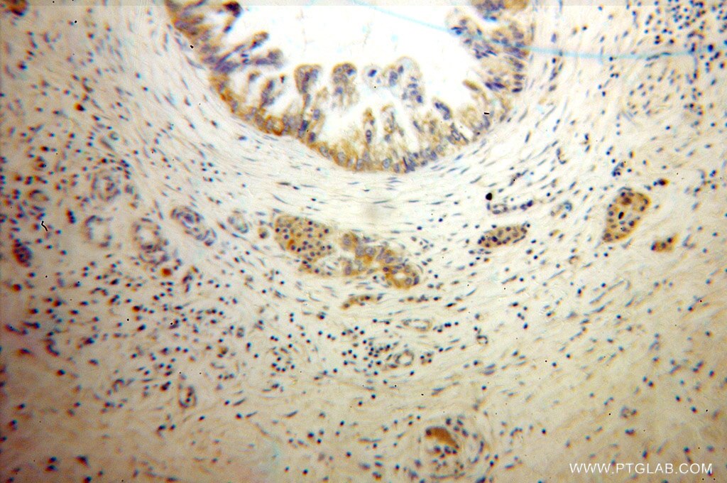 Immunohistochemistry (IHC) staining of human pancreas cancer tissue using ECM1 Polyclonal antibody (11521-1-AP)