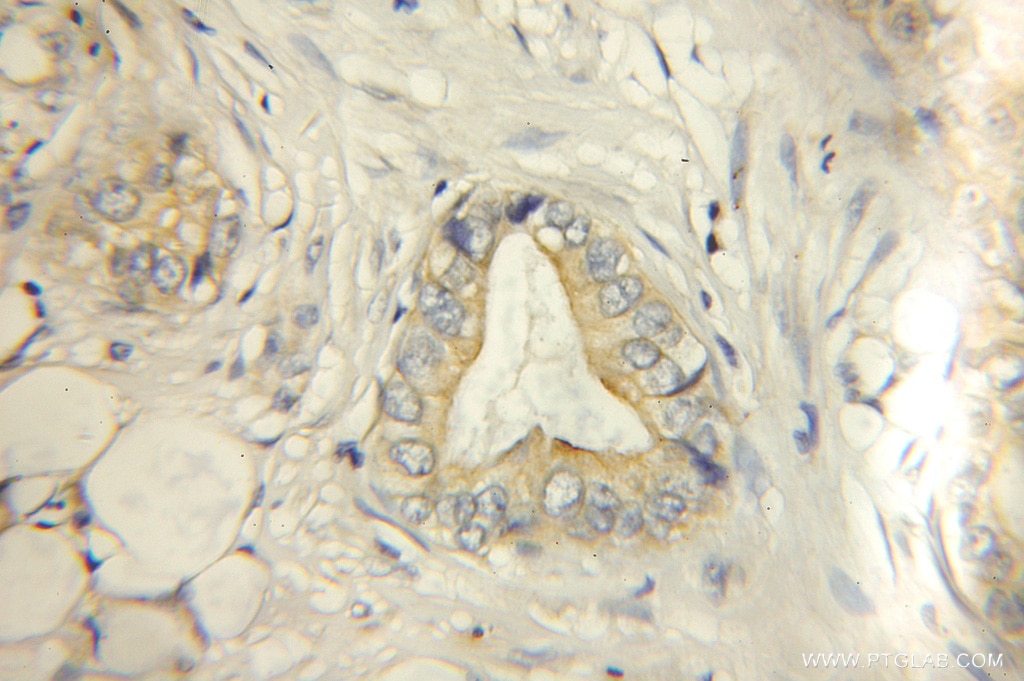 IHC staining of human lung cancer using 11521-1-AP