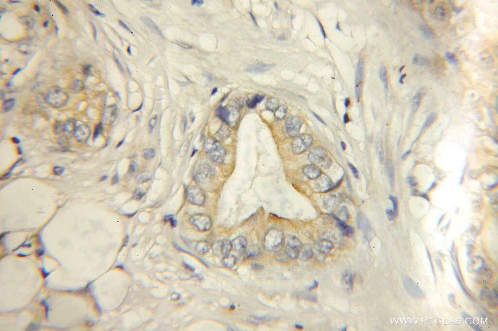 Immunohistochemistry (IHC) staining of human lung cancer tissue using ECM1 Polyclonal antibody (11521-1-AP)