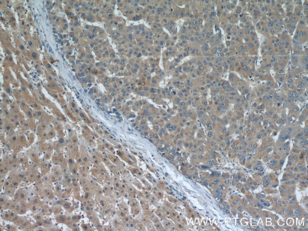 Immunohistochemistry (IHC) staining of human liver cancer tissue using ECM1 Monoclonal antibody (66023-1-Ig)
