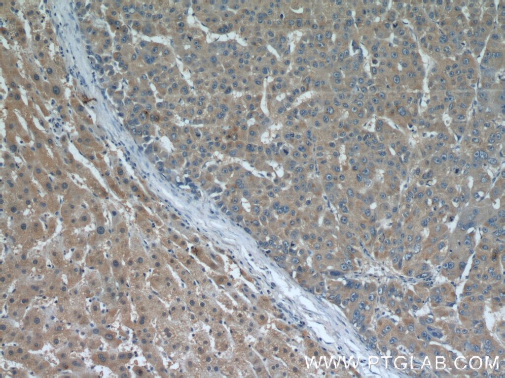 Immunohistochemistry (IHC) staining of human liver cancer tissue using ECM1 Monoclonal antibody (66023-1-Ig)