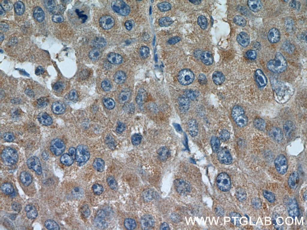 Immunohistochemistry (IHC) staining of human liver cancer tissue using ECM1 Monoclonal antibody (66023-1-Ig)