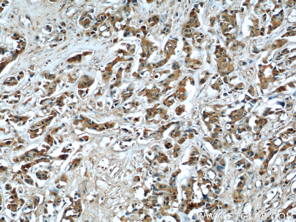 IHC staining of human breast cancer using 66023-1-Ig