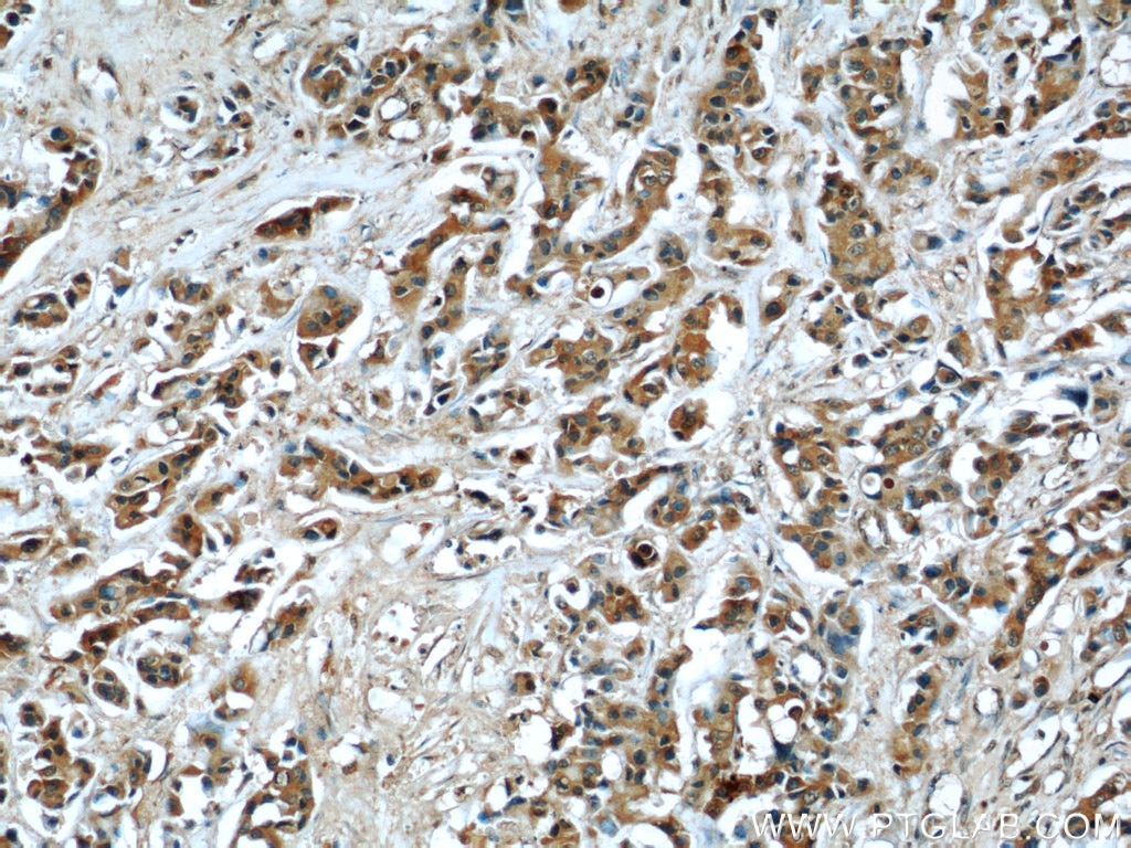 Immunohistochemistry (IHC) staining of human breast cancer tissue using ECM1 Monoclonal antibody (66023-1-Ig)