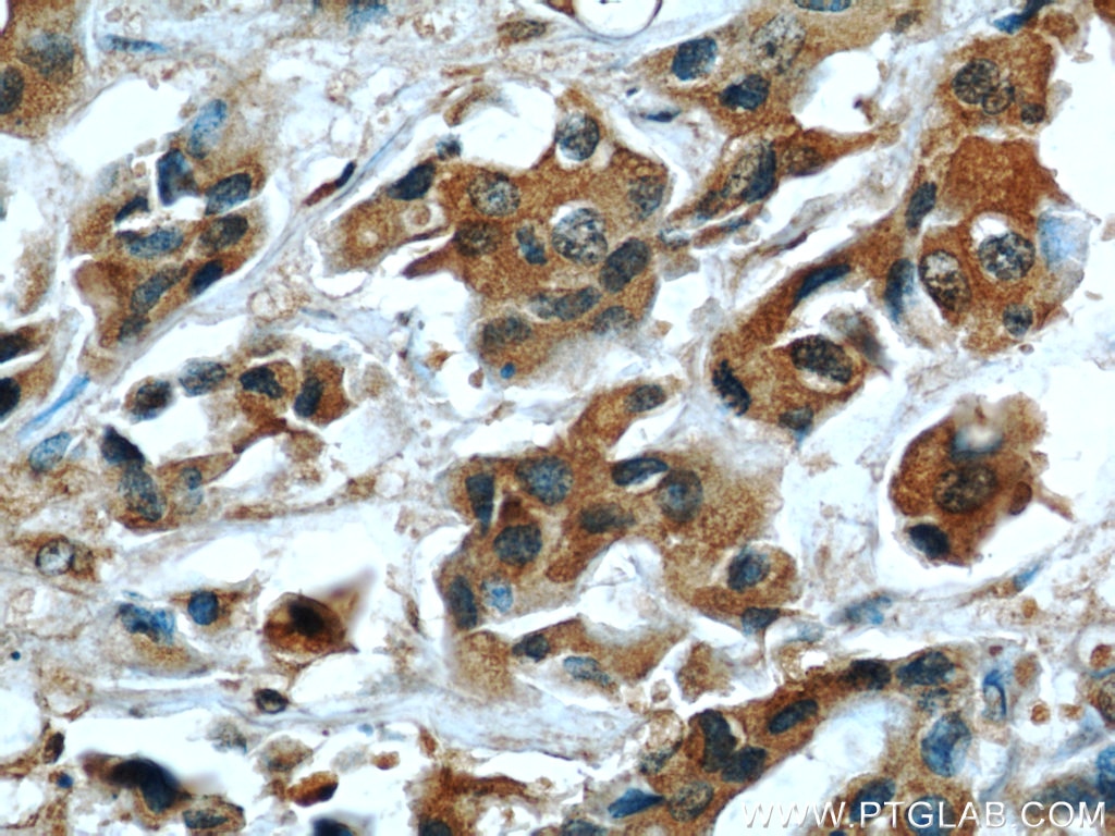 Immunohistochemistry (IHC) staining of human breast cancer tissue using ECM1 Monoclonal antibody (66023-1-Ig)