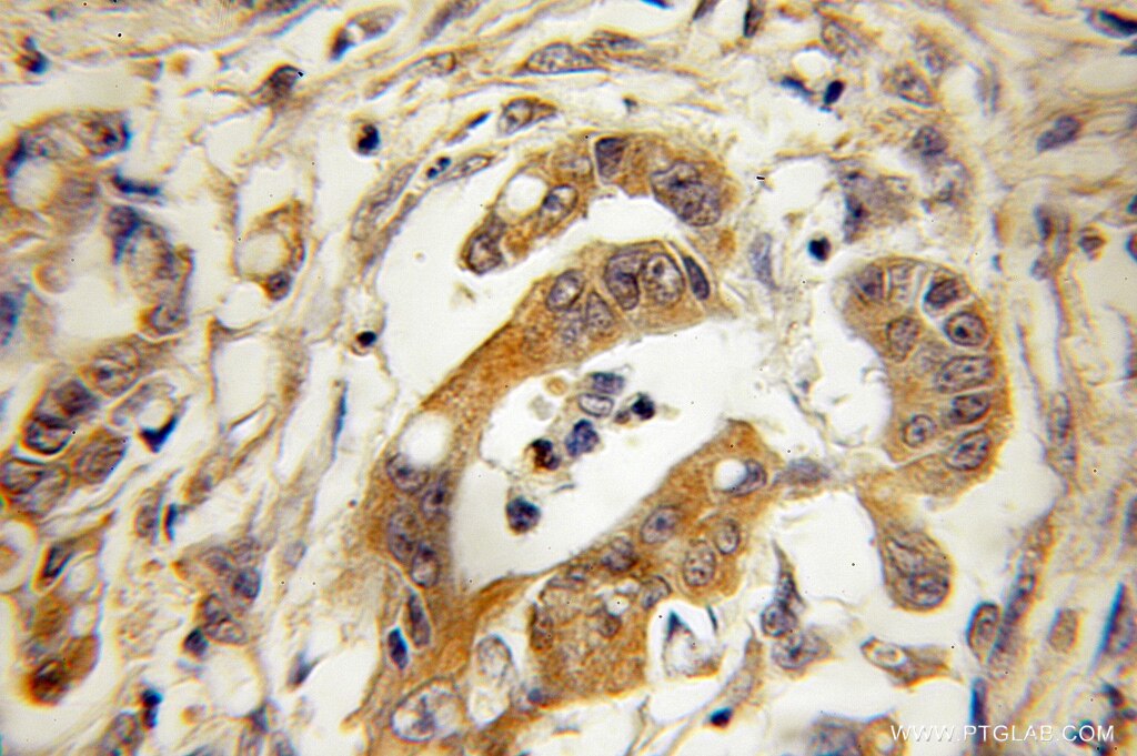 Immunohistochemistry (IHC) staining of human colon cancer tissue using ECSIT Polyclonal antibody (10577-1-AP)
