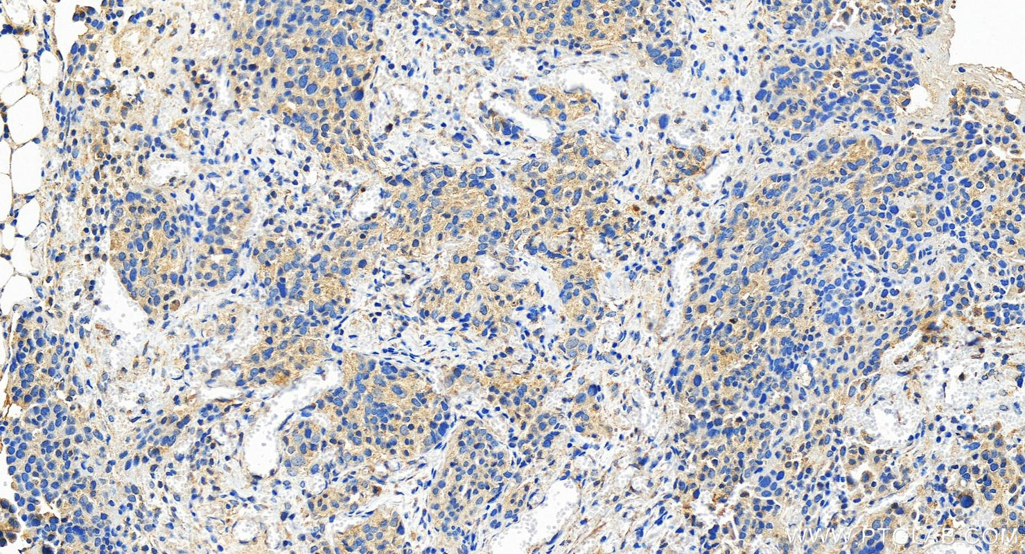 Immunohistochemistry (IHC) staining of human ovary cancer tissue using ECSIT Polyclonal antibody (27548-1-AP)