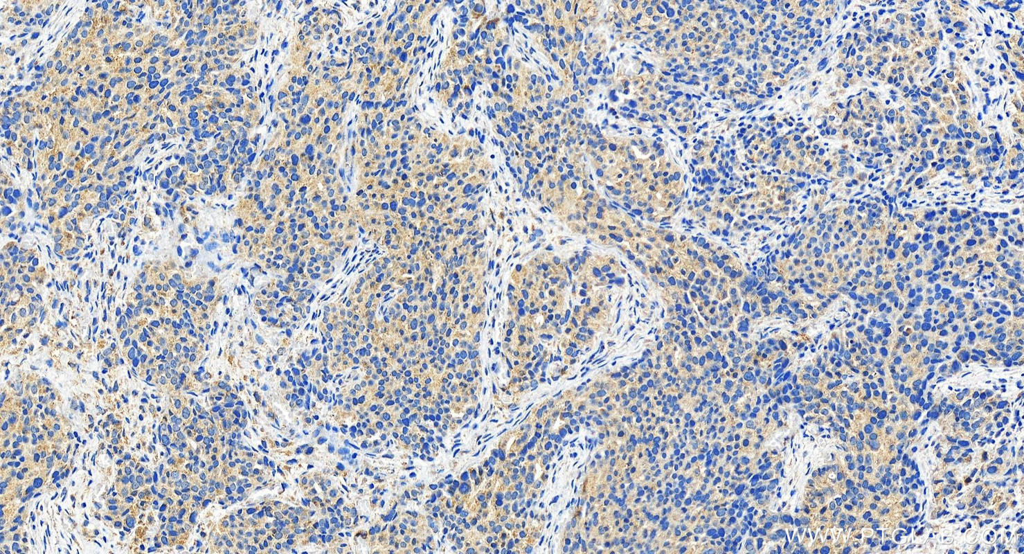 Immunohistochemistry (IHC) staining of human ovary cancer tissue using ECSIT Polyclonal antibody (27548-1-AP)