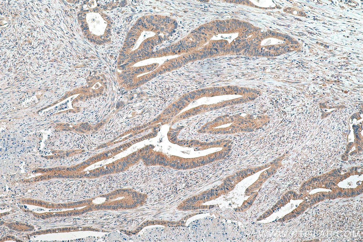 Immunohistochemistry (IHC) staining of human colon cancer tissue using EDC4 Polyclonal antibody (17737-1-AP)