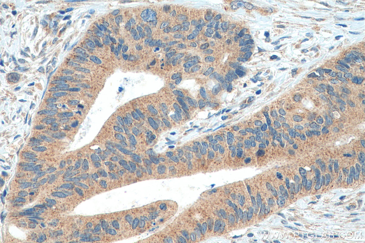 Immunohistochemistry (IHC) staining of human colon cancer tissue using EDC4 Polyclonal antibody (17737-1-AP)