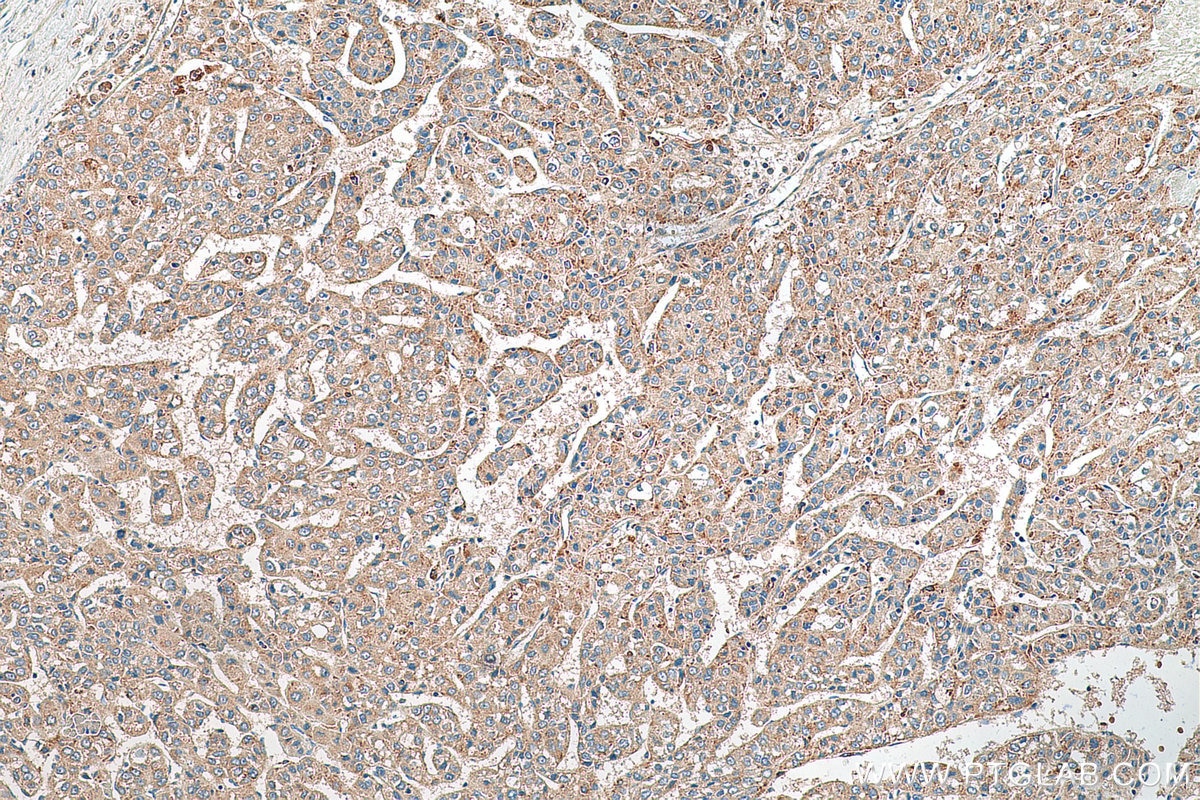 Immunohistochemistry (IHC) staining of human liver cancer tissue using EDC4 Polyclonal antibody (17737-1-AP)