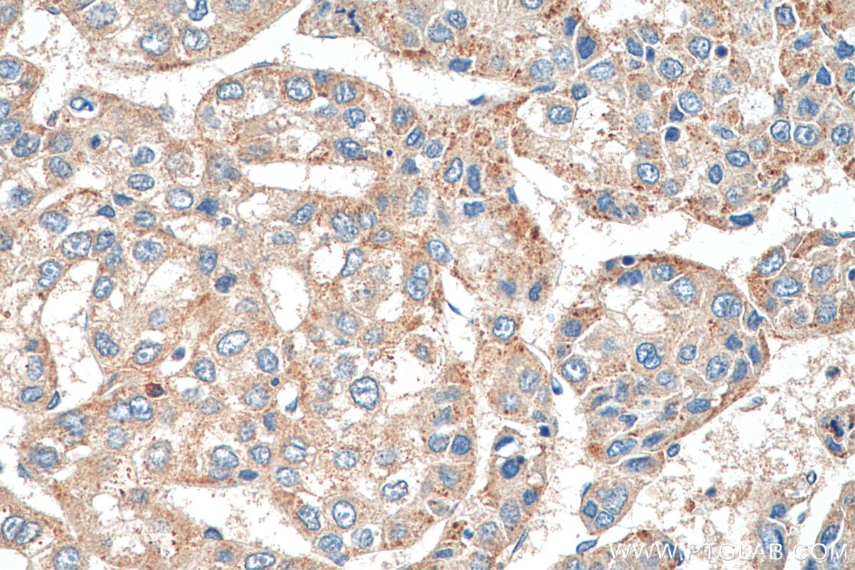 Immunohistochemistry (IHC) staining of human liver cancer tissue using EDC4 Polyclonal antibody (17737-1-AP)