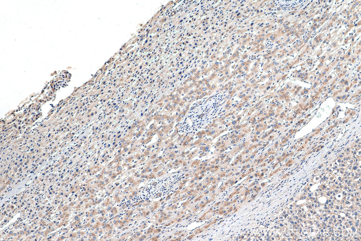 Immunohistochemistry (IHC) staining of human liver cancer tissue using EDEM1 Polyclonal antibody (26226-1-AP)