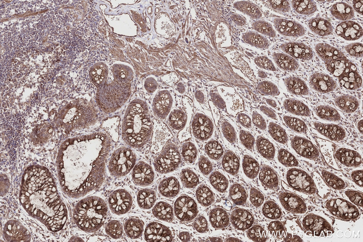 IHC staining of human rectal cancer using 26226-1-AP Immunohistochemistry (IHC) staining of human rectal cancer tissue using EDEM1 Polyclonal antibody (26226-1-AP)