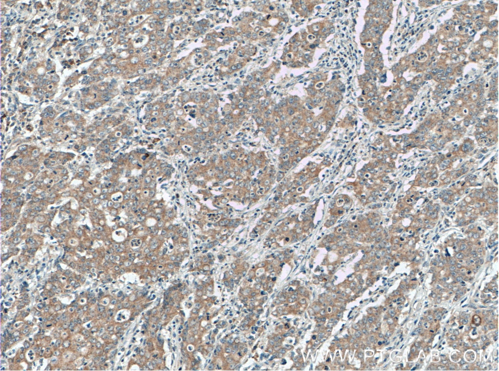 Immunohistochemistry (IHC) staining of human stomach cancer tissue using EDEM3 Polyclonal antibody (27310-1-AP)