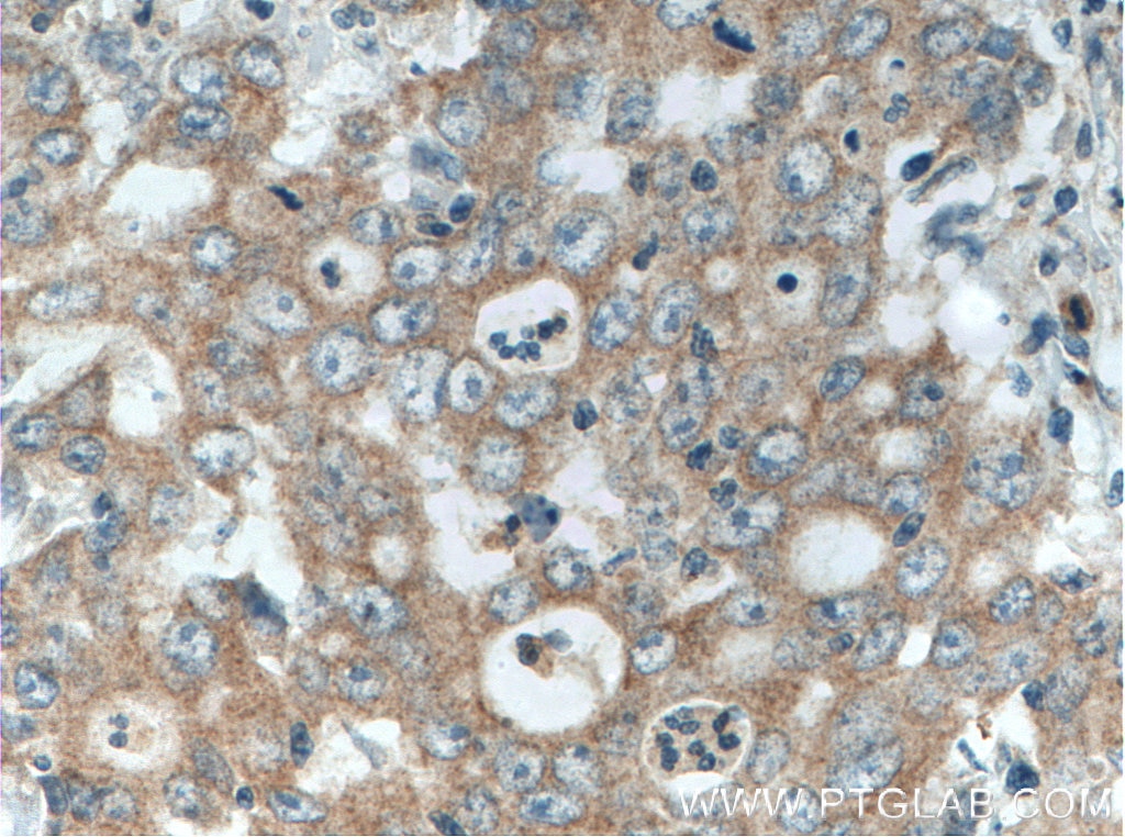 IHC staining of human stomach cancer using 27310-1-AP